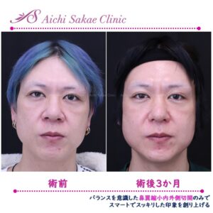 40代　鼻翼縮小内外側切開