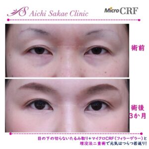 40代　目の下の切らないたるみ取り＋ｍCRF（目の下・ゴルゴ）