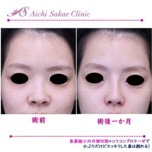 20代　シリコンプロテーゼ＋鼻翼縮小内外側切開
