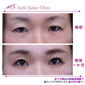 40代　眉下切開