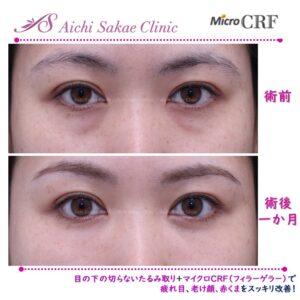 30代　目の下の切らないたるみ取り＋ｍＣＲＦ（目の下ゴルゴ）