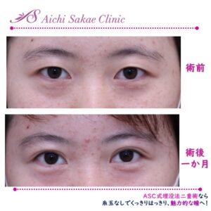 20代　グランドアイ（韓流特殊６点埋没法二重術）