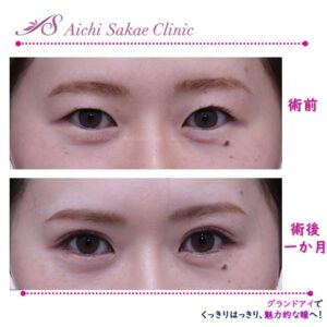 20代　グランドアイ（韓流特殊６点埋没法二重術）