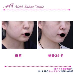 20代　頬顎下脂肪吸引