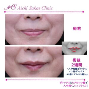50代　にっこリップ＋人中短縮ボトックス