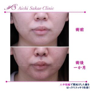 20代　人中短縮