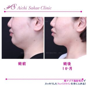 40代　頬顎下脂肪吸引