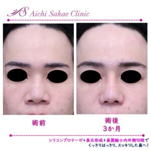20代　シリコンプロテーゼ＋鼻尖形成＋鼻翼縮小内外側切開