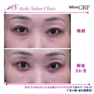 40代 目の下の切らないたるみ取り＋マイクロCRF