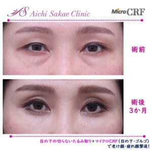 40代　目の下の切らないたるみ取り＋マイクロCRF（目の下・ゴルゴ）