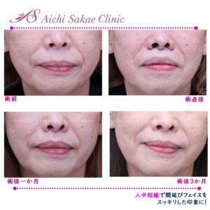 60代　人中短縮