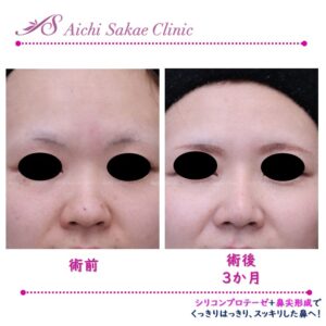 20代　シリコンプロテーゼ＋鼻尖形成＋軟骨移植