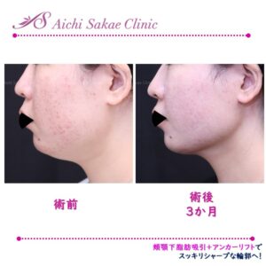 20代　頬顎下脂肪吸引＋アンカーリフト