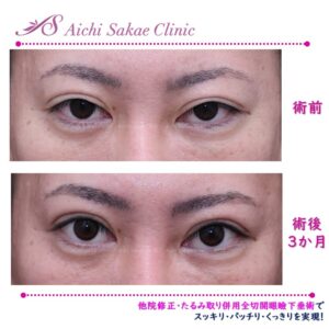 40代男性　他院修正・たるみとり併用全切開眼瞼下垂術