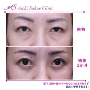 40代女性　眉下切開＋目の下の切らないたるみ取り