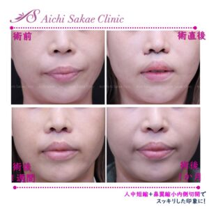 40代　人中短縮＋鼻翼縮小内側切開