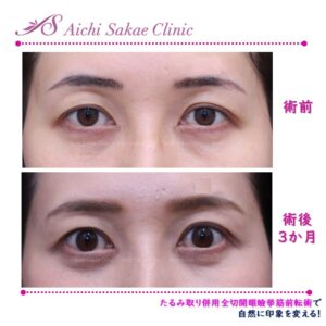 50代　たるみ取り併用全切開＋挙筋前転術