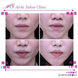 40代　人中短縮