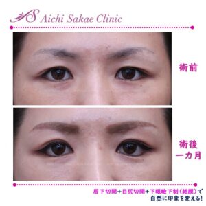 40代　眉下切開＋目尻切開＋グラマラスライン