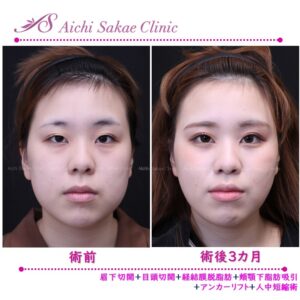 20代　全顔モニター