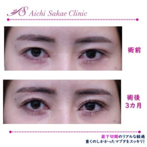 30代　眉下切開