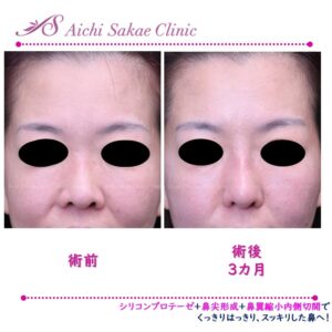 30代　シリコンプロテーゼ＋鼻尖形成＋鼻翼縮小内外側切開