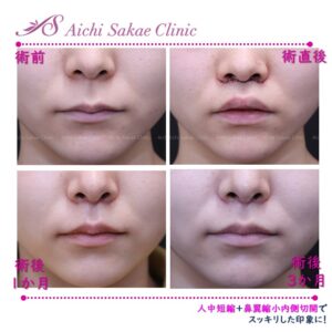 20代　人中短縮＋鼻翼縮小内側切開