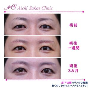 50代　眉下切開