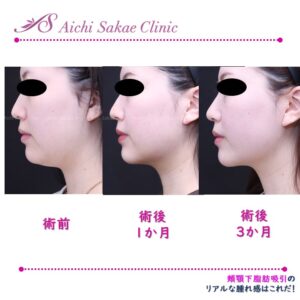 20代　頬顎下脂肪吸引