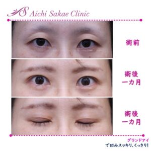 40代グランドアイで窪み目を改善