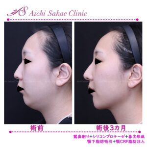 30代鷲鼻削りを含む鼻整形＋顎下脂肪吸引＋顎脂肪注入