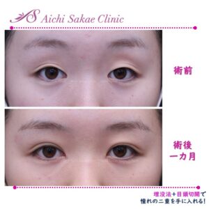 20代目頭切開（Z法）＋埋没法