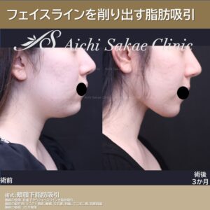 30代　頬顎下脂肪吸引