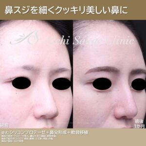 20代　シリコンプロテーゼ＋鼻尖形成＋軟骨移植