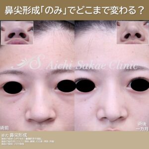 20代　鼻尖形成　単独