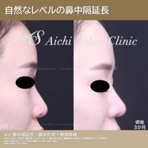 20代　鼻中隔延長