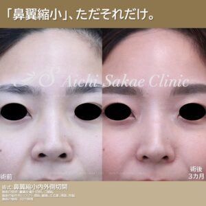 20代　鼻翼縮小内外側切開　単独