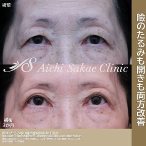 60代　たるみ取り併用全切開＋眼瞼下垂術