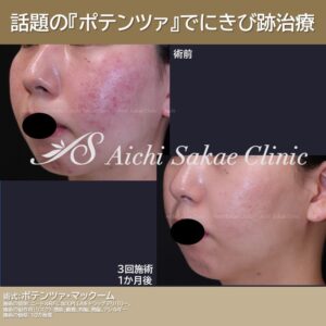 20代　Potenza with Macoom