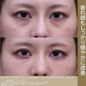 20代　経結膜脱脂＋マイクロCRF（目の下・ゴルゴ）