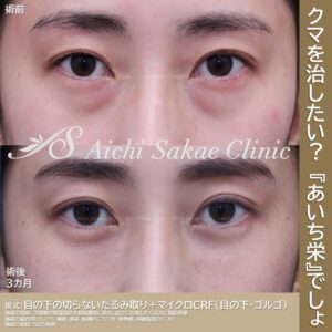 40代　切らない目の下のたるみ取り＋マイクロCRF（目の下・ゴルゴ）