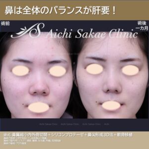 20代　鼻整形
