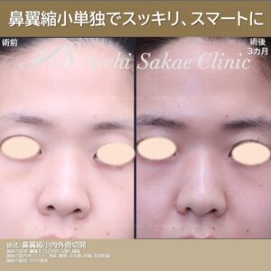 20代　鼻翼縮小内外側切開単独