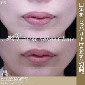 20代　口角挙上