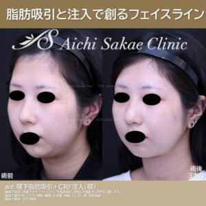 20代　頬顎下脂肪吸引