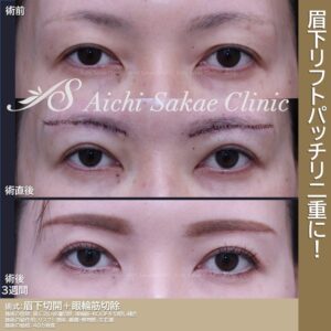 30代　眉下切開