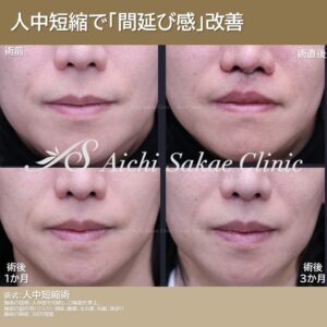 40代　メンズ人中短縮