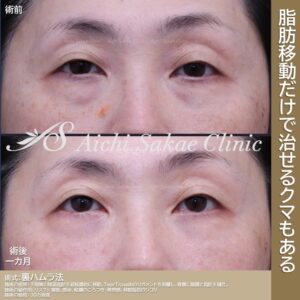 30代　裏ハムラ