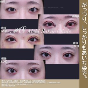 20代　目頭切開＋たるみ取り併用全切開眼瞼下垂＋経結膜脱脂