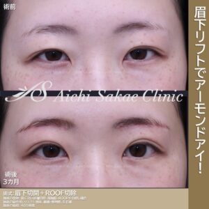 20代　眉下切開